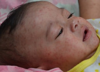 Τριπλασιάστηκαν σε έναν χρόνο τα κρούσματα ιλαράς παγκοσμίως