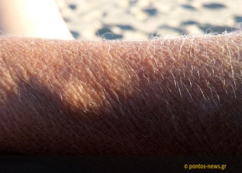 Ερευνητές δημιουργούν ζωντανό δέρμα σε τρισδιάστατη μορφή