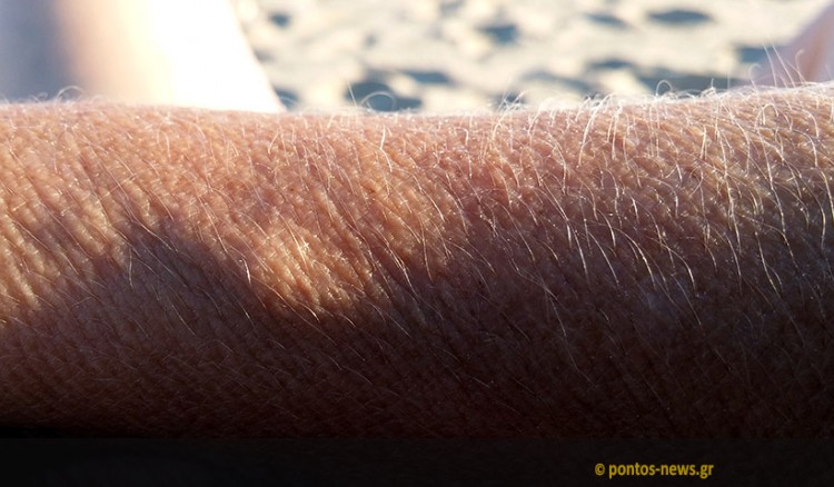 Ερευνητές δημιουργούν ζωντανό δέρμα σε τρισδιάστατη μορφή