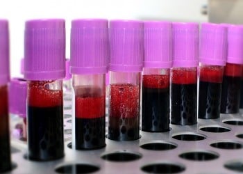 Covid-19 και ομάδα αίματος: Ποιοι κινδυνεύουν περισσότερο