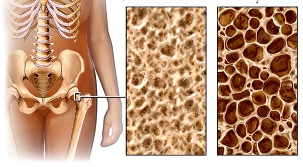 Παγκόσμια Ημέρα Οστεοπόρωσης